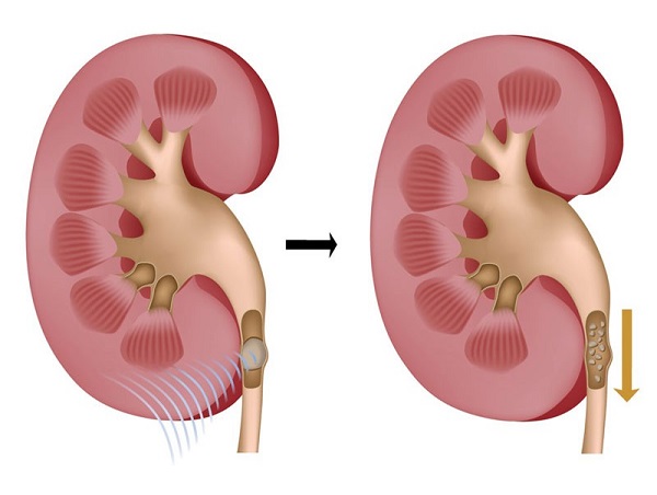 tán sỏi tiết niệu ngoài cơ thể