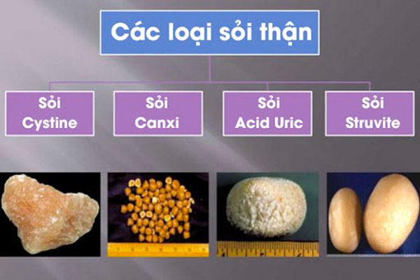 Các loại sỏi thận