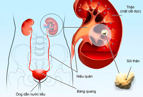 Các phương pháp điều trị bệnh sỏi thận