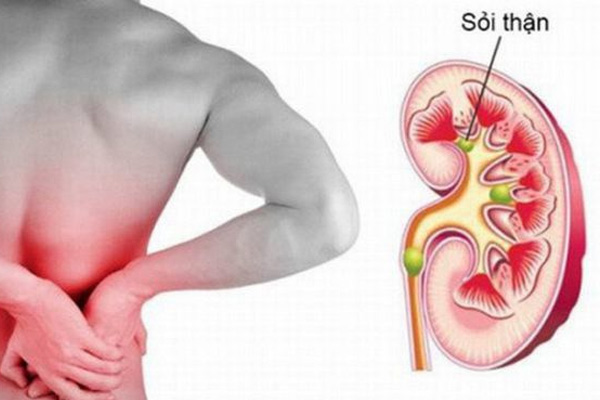 Sỏi thận đài dưới: Dấu hiệu nhận biết và cách phòng ngừa