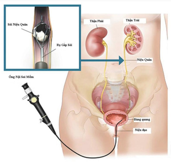 Điều trị sỏi niệu quản nội thành bàng quang